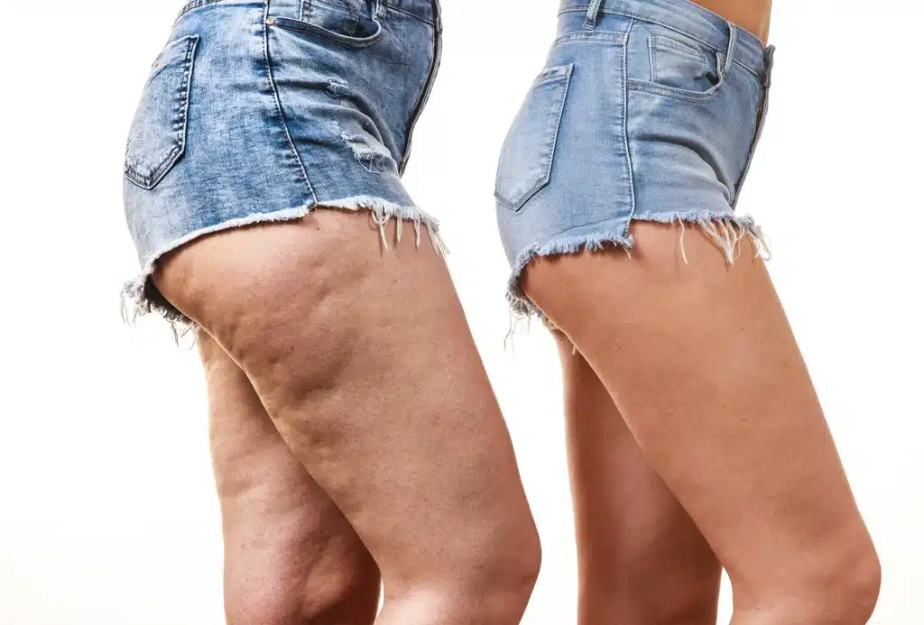 beneficios de treinar posterior da coxa