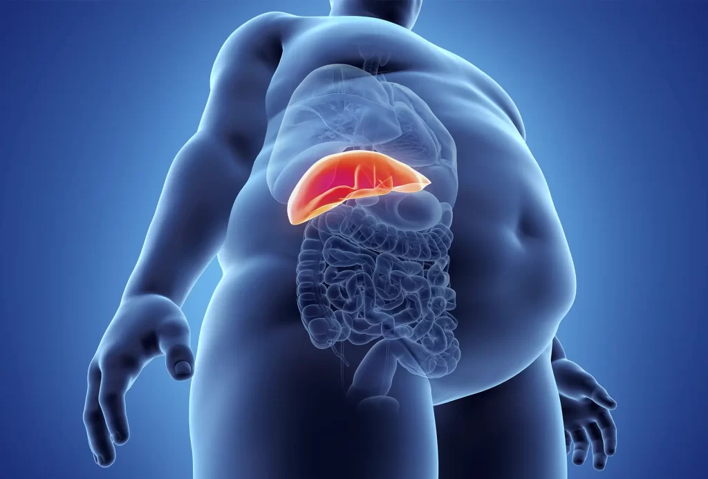 riscos da obesidade gordura visceral
