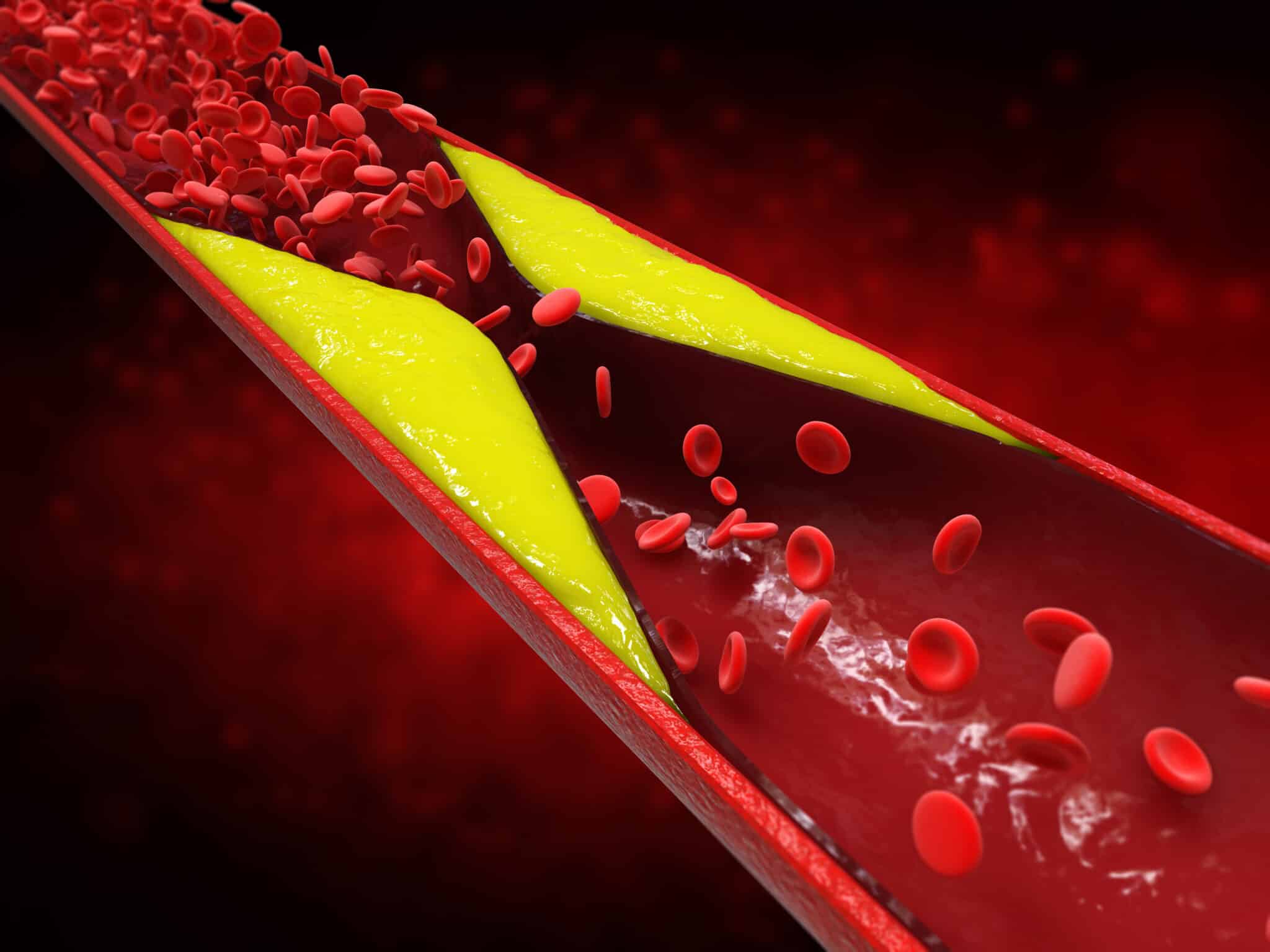 controlar o colesterol 3d rendering atherosclerosis with cholesterol blood or plaque in vessel cause of coronary artery disease