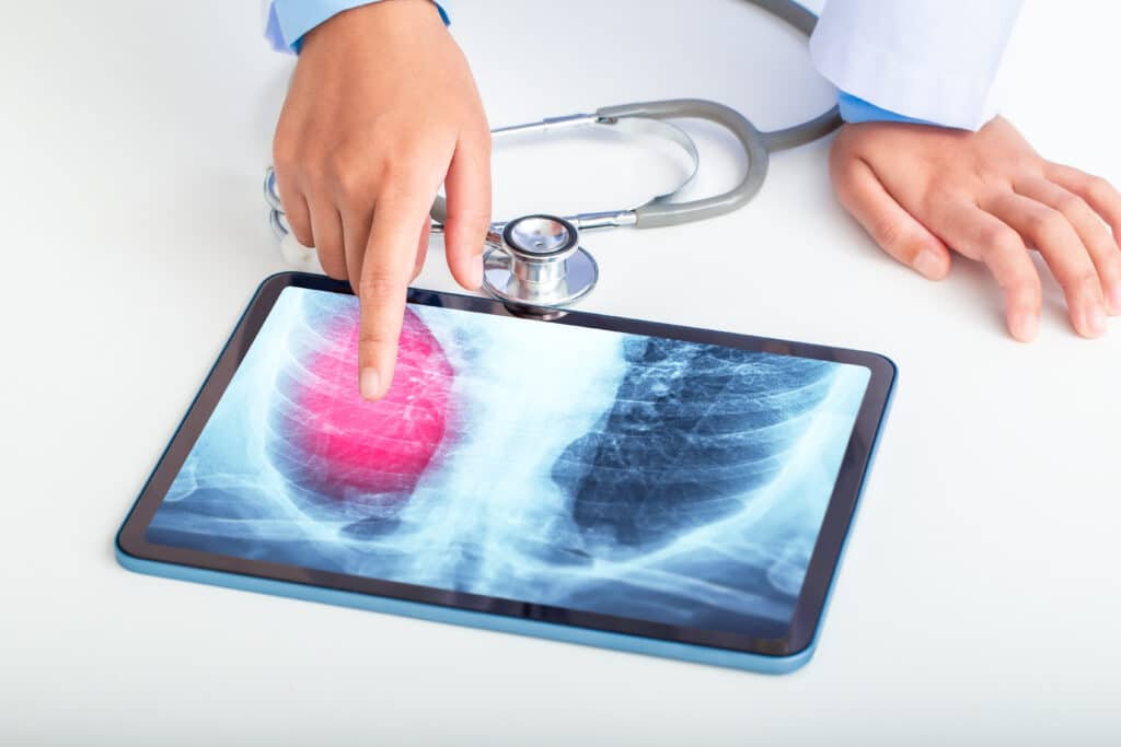 corpo humano pulmões saúde pulmonar coração raio x pneumonia